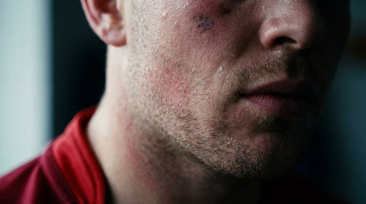 Close-up of a rugby player's face showing post-scrum skin contact - scrumpox herpes rugbiorum awareness